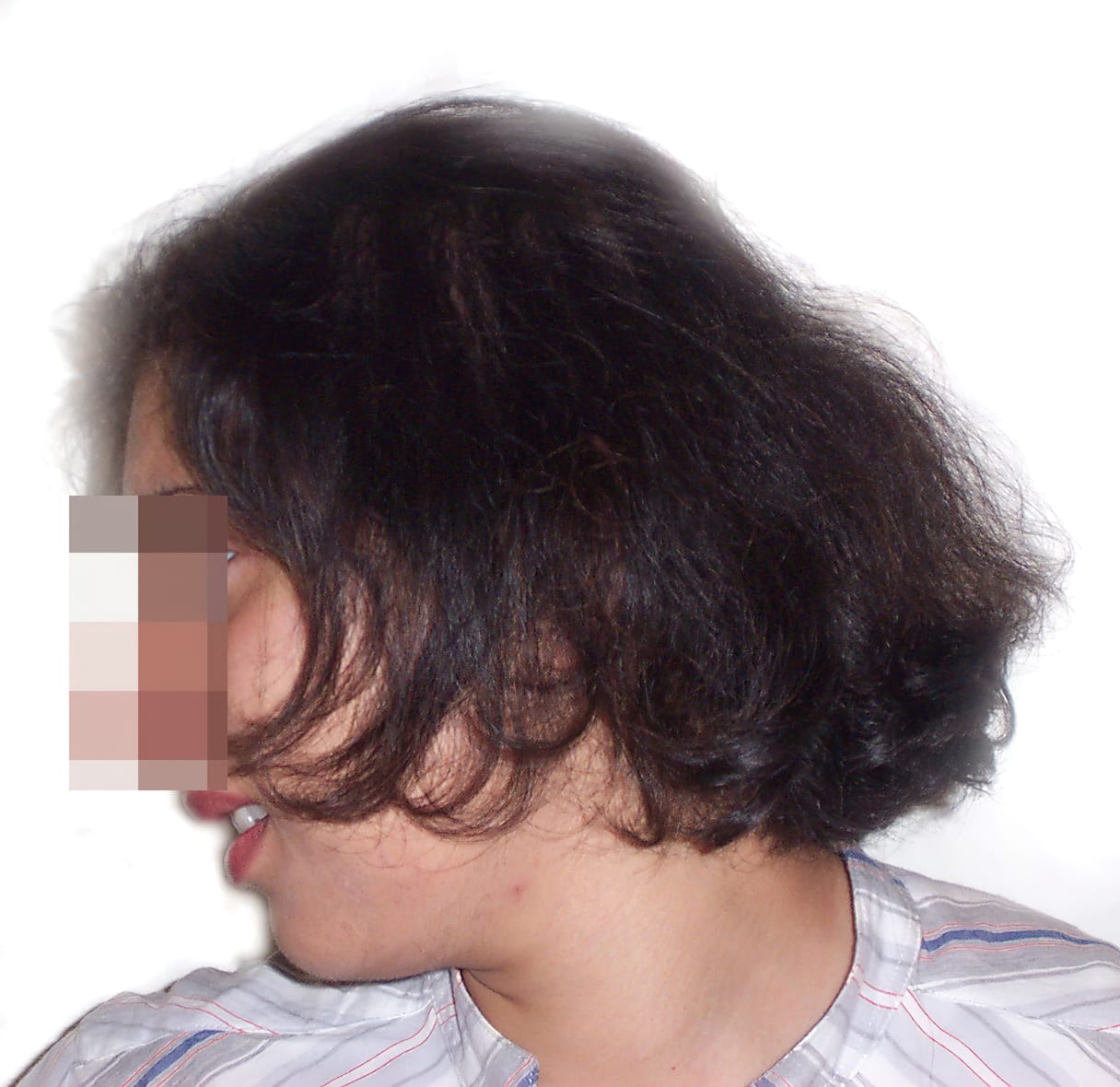 Before Picture - Androgenetic Alopecia / Stress